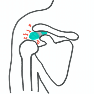 Skuldersmerter : Smerter på siden af skulderen