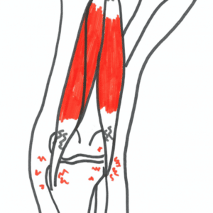 Øvelser for overbelastning af baglåret Overbelastningsskade i knæet
