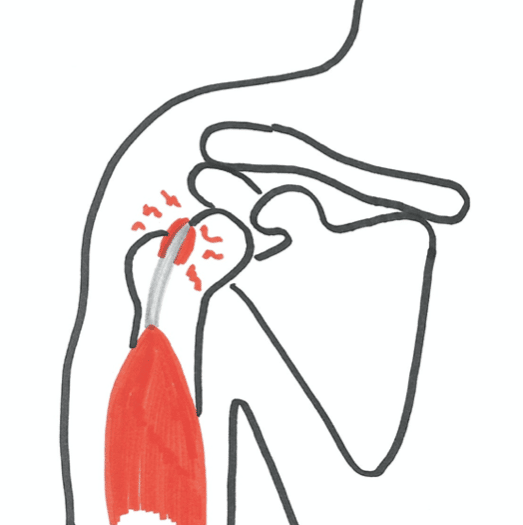 Smerter på forsiden af skulderen