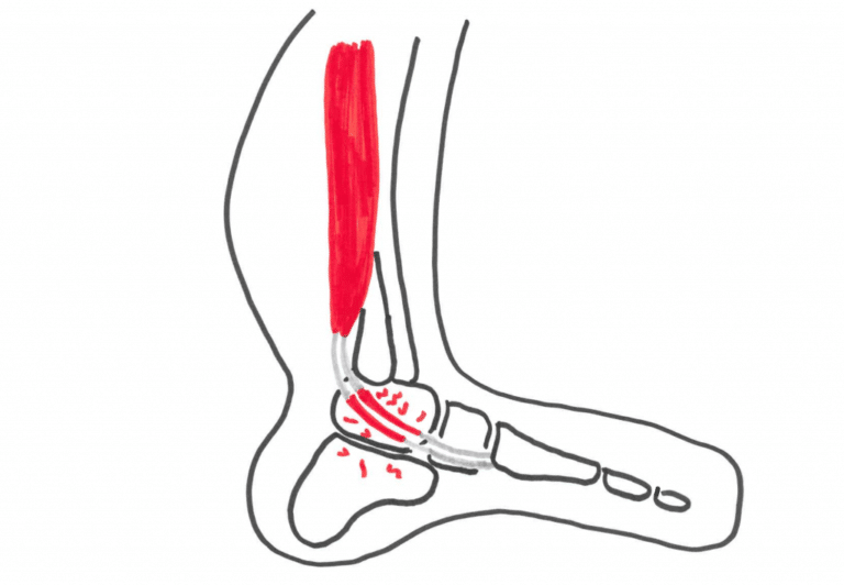 Overbelastningsskade i ankel og fod Smerter på ydersiden af anklen