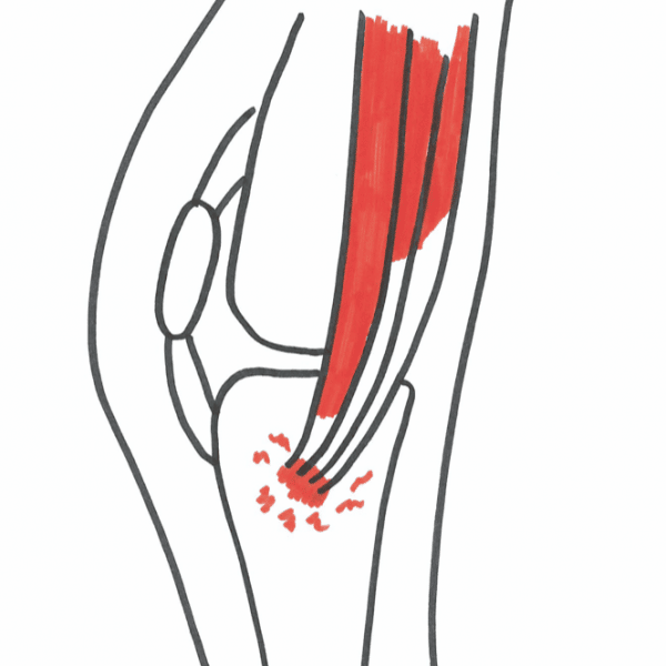 Knæsmerter : Smerter på indersiden af knæet kan skyldes en overbelastning af pes anserius senen | pes anserinus tendinitt