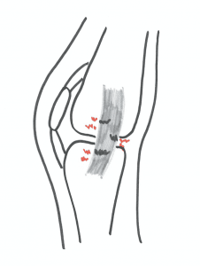 Smerter på indersiden af knæet