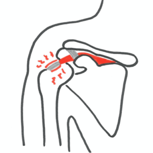 Overbelastningsskade i skulderen smerter på forsiden af skulderen