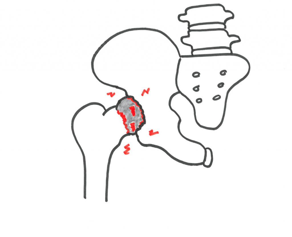 Smerter på forsiden af hoften