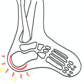 Smerter i hælen defineres som smerter ved hælbenet (også kaldt Calcaneus)