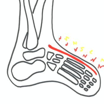 Smerter ovenpå foden fodsmerter