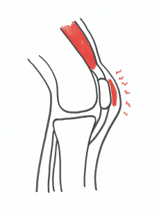 Smerter i knæet : Slimsækkebetændelse Overbelastningsskade i knæet