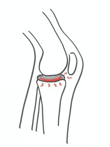 Knæsmerter : Smerter på forsiden af knæet