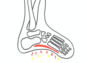 Løbeskader smerter under foden