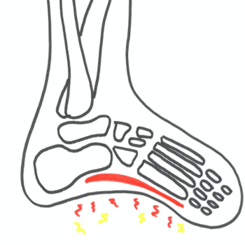 under foden | Typiske årsager symptomer