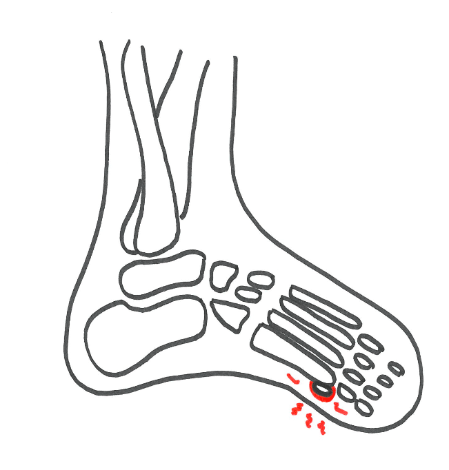 Smerter under foden sesamknogle