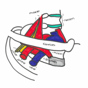 Thoracic outlet syndrome