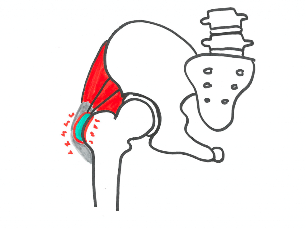 Smerter på forsiden af hoften øvelser for trokanterbursit smerter på ydersiden af hoften